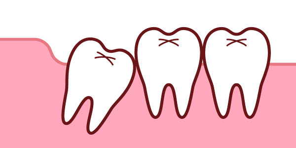 水平埋伏(真横を向いている)