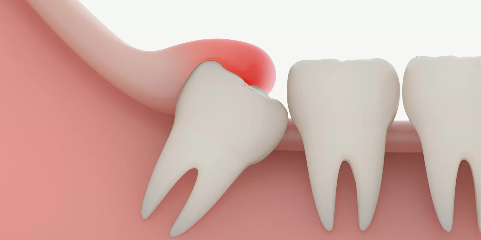 親知らずの基礎知識