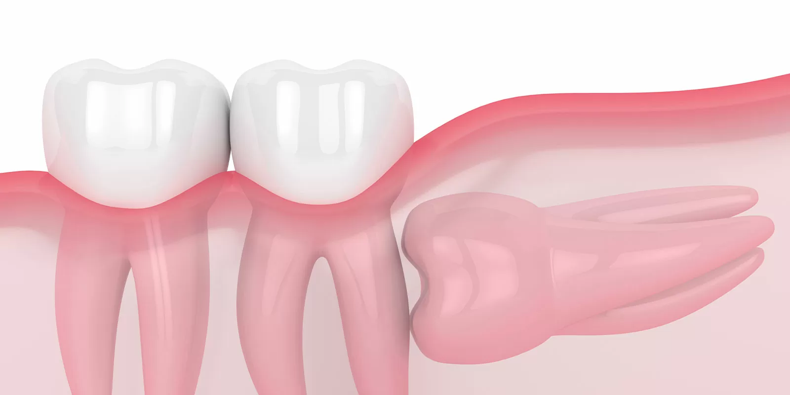 切開が必要になる代表的なケース