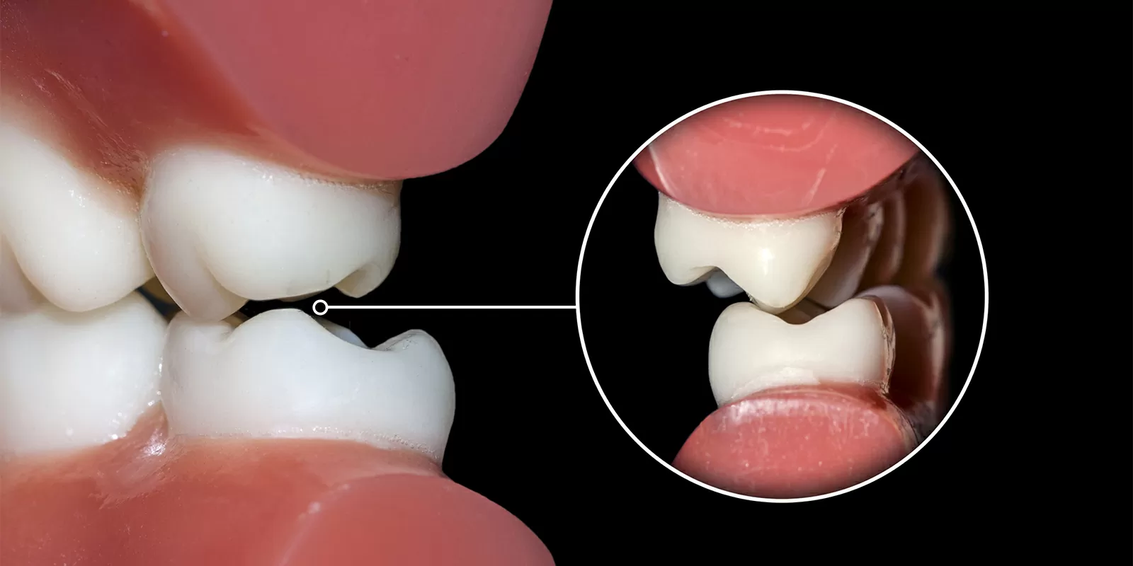 原因1：咬み合わせの乱れによる筋肉の緊張