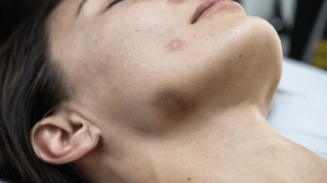 抜歯後の「あざ（内出血）」ができるメカニズム