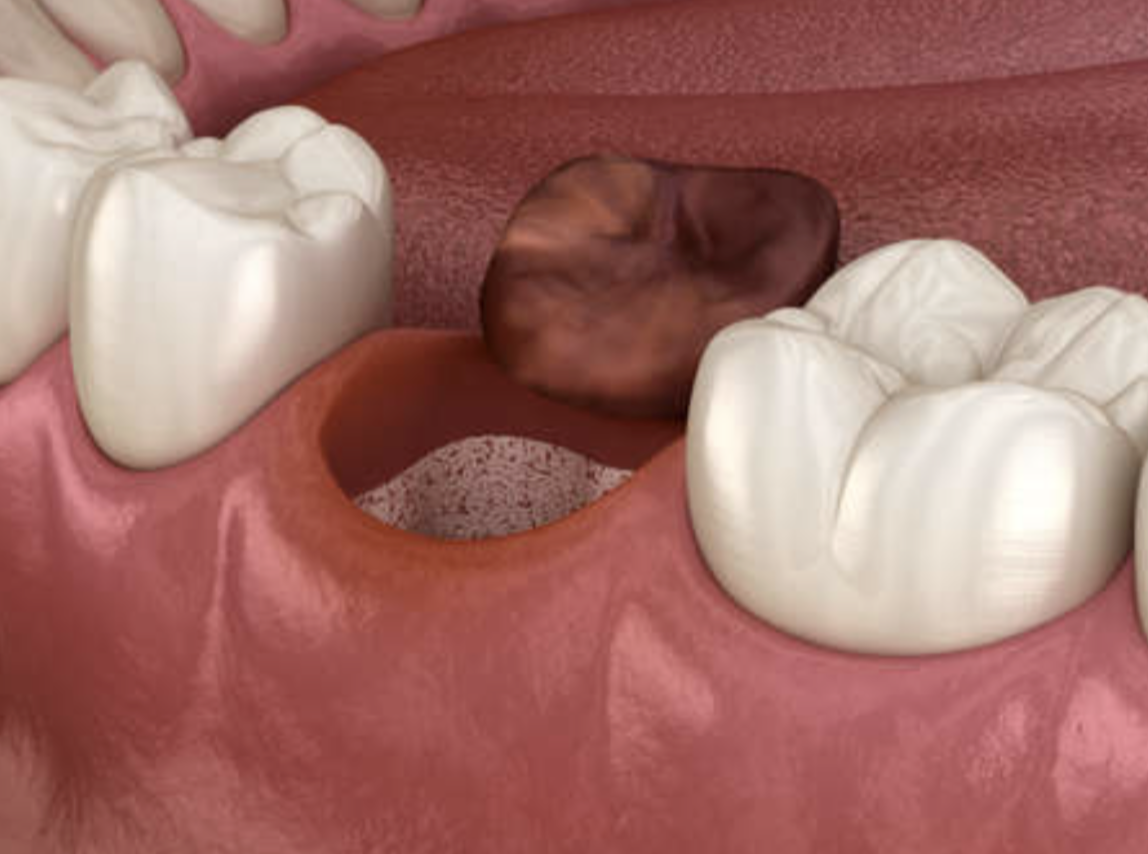 激痛を伴う「ドライソケット」の正体