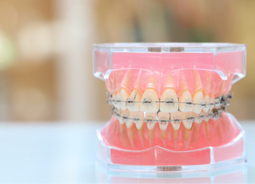 矯正治療後の「後戻り」を防ぐために